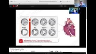 TAVR Webinar with Dr. Eric King