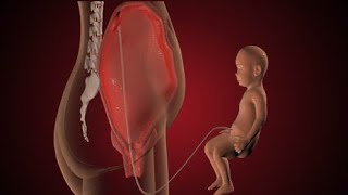 Child Birth (3D Animation)
