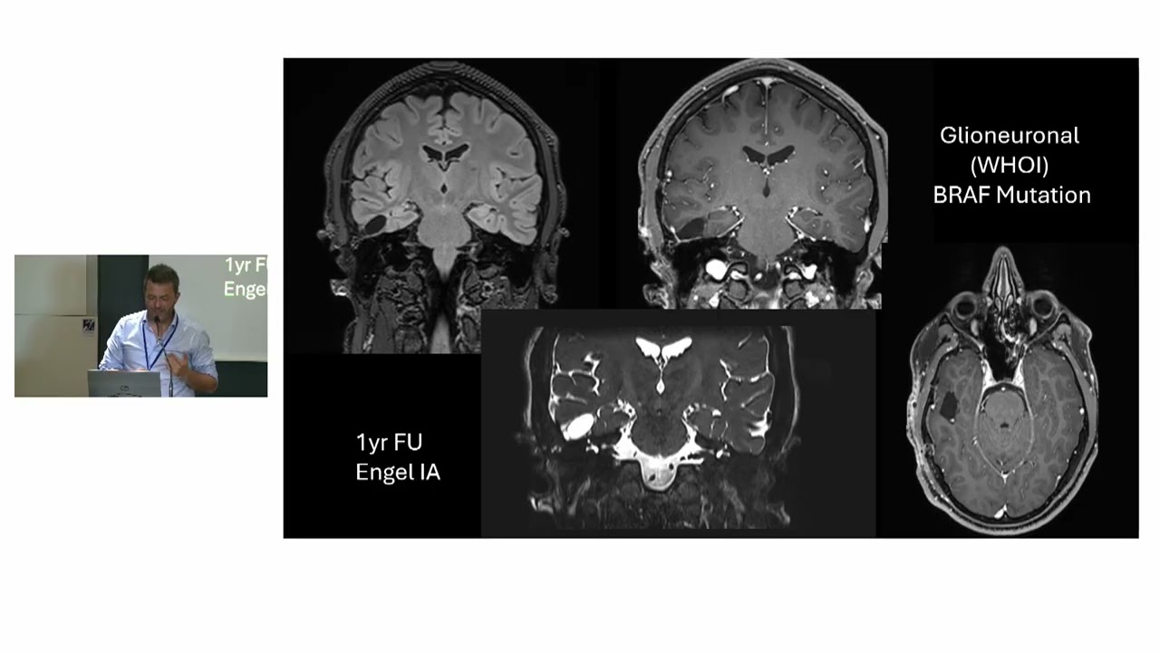 Pediatric Low Grade Glioma: LITT in pLGG: what is the current evidence?