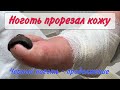 Страшный ноготь/ ноготь врезался в кожу/старческие ногти