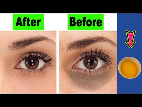 The best natural remedy for tired eyes and dark circles around the eyes
