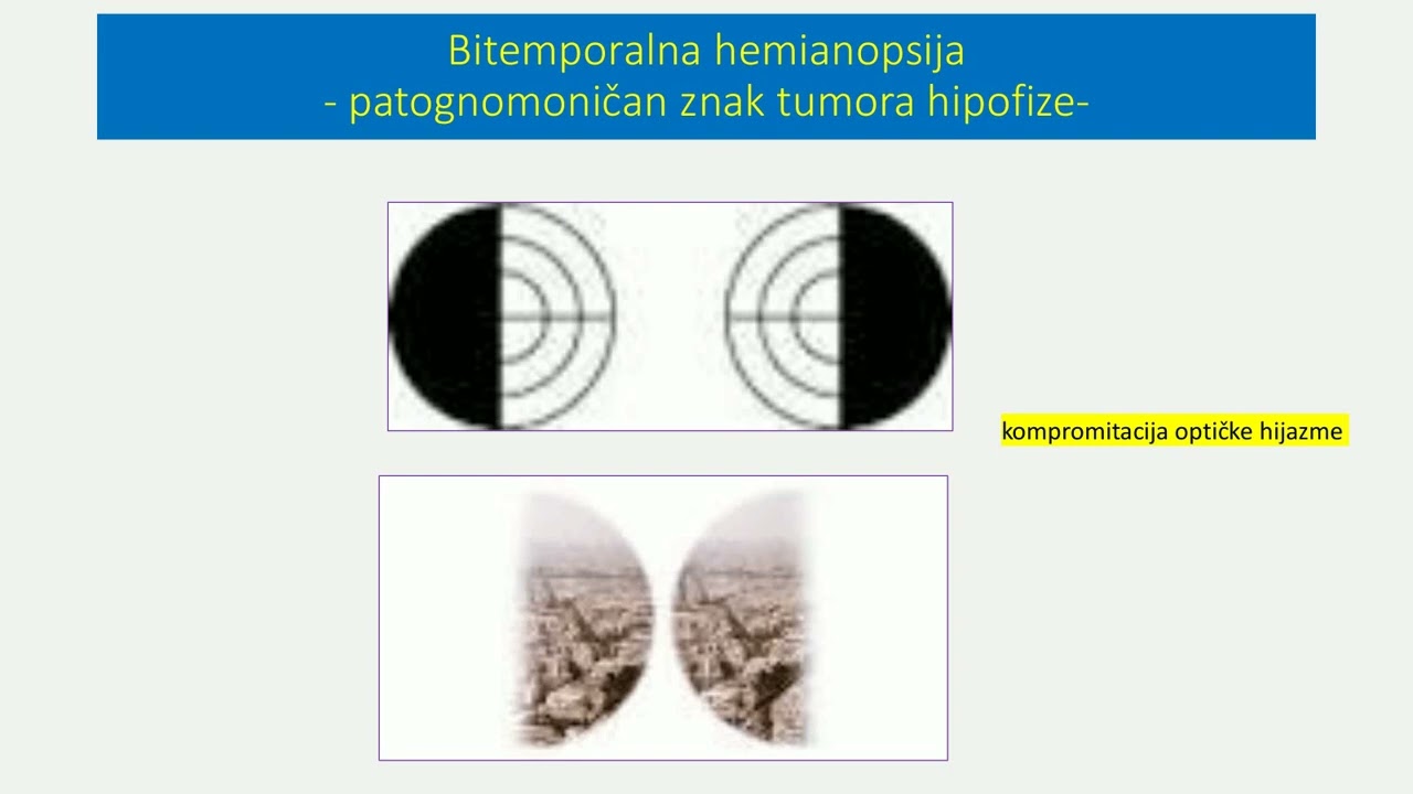 Tumori hipofize prof dr Mirjana Doknić   Pacijenti sa tumorom hipofize i dijagnostika