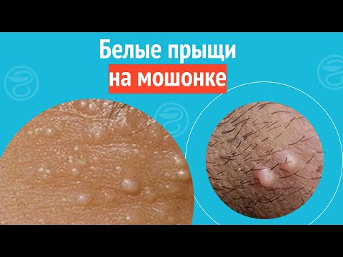 🥺 Белые прыщи на мошонке. Клинический случай №1247