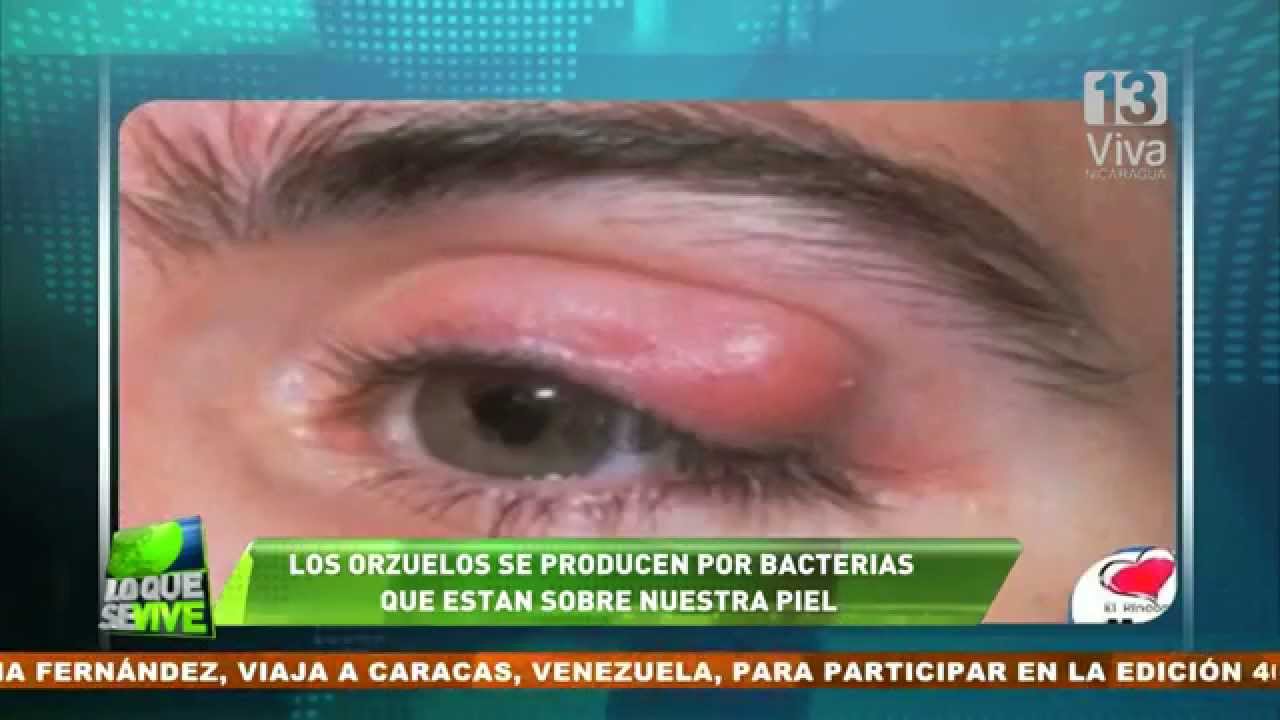 remedio contra orzuelos en los ojos remedio contra orzuelos en los ojos
