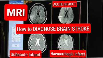 BRAIN stroke Diagnosis | Acute Infarct | Subacute Infarct | Hemorrhagic Infarct on MRI
