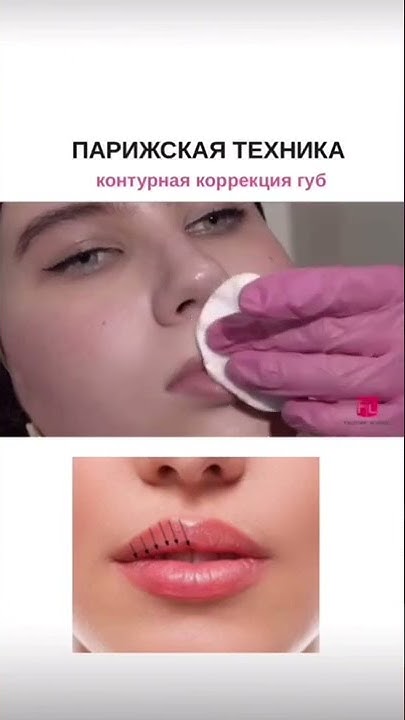 Парижские губы фото до и после Lip fillers provide a quick and easy way to add extra volume and shape to lips.