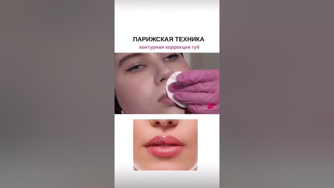 Парижская техника увеличения губ до и после Французская техника увеличения губ * методика парижская технология, фото до и по