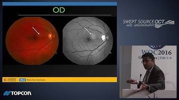 NEW FRONTIERS IN OCT  SWEPT SOURCE AND OCT ANGIOGRAPHY