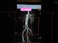 CT Angiogram #shorts