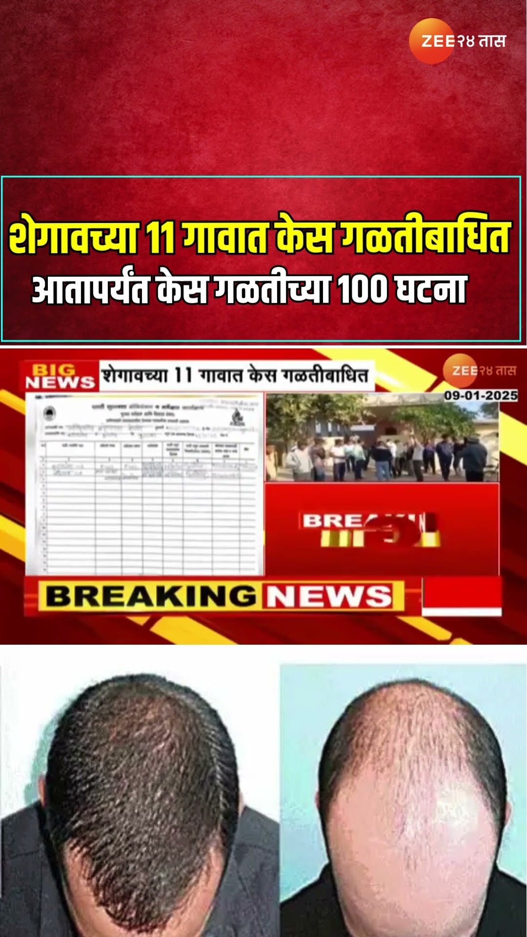 Shegaon Hair Problem | शेगावच्या 11 गावात केस गळतीबाधित ; आतापर्यंत केस गळतीच्या 100 घटना