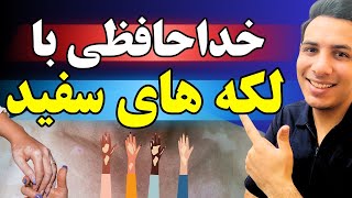 نسخه جادویی درمان برص، پیسی، ویتیلیگو| درمان لکه های سفید پوستی