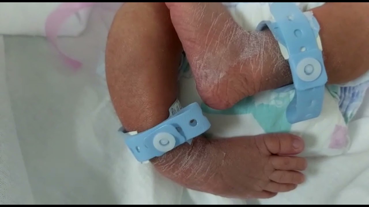 case 649 congital Talipes equinovarus, CTEV, Tali= ankle, pes=foot