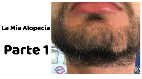 Perché ho i buchi nella barba?