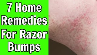 7 Home Remedies for Razor Bumps and How To Use Them