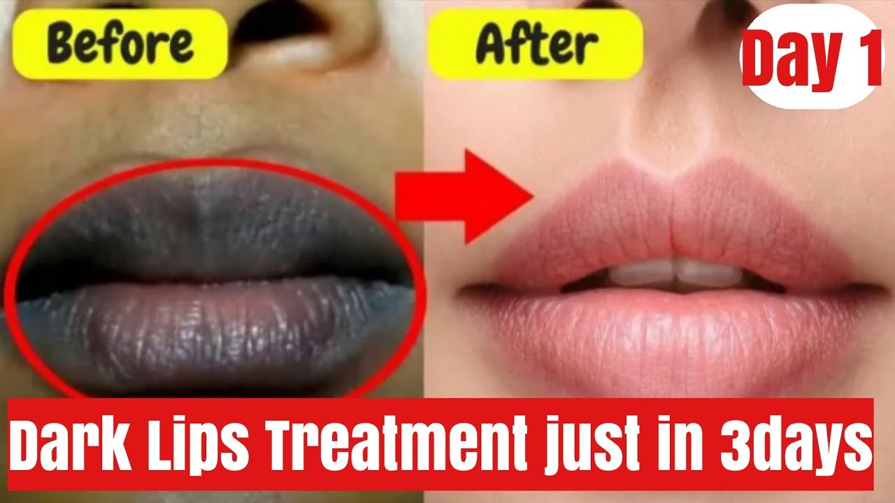 How To Get Baby Soft Pink Lips 3Days Dark Lips Removal Challenge Day how-to-get-baby-soft-pink-lips-3days-dark-lips-removal-challenge-day