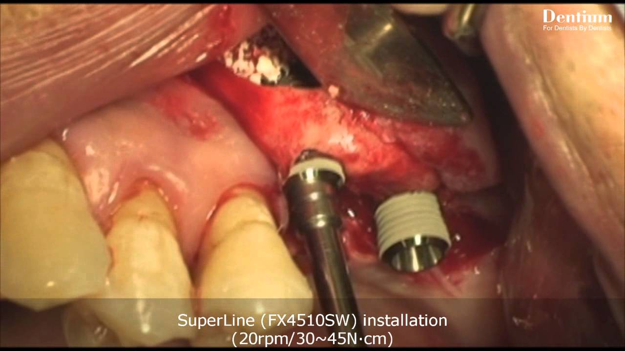 Sinus elevation - lateral approach (Perforation Case)