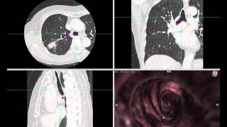Virtual Bronchoscopy Using OsiriX 7.0