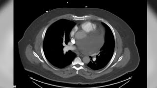 Skin Cancer to the Heart - Kyle's Remarkable Journey