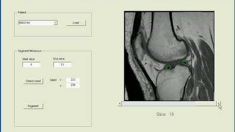 Semi-Automated Meniscus Segmentation Demo