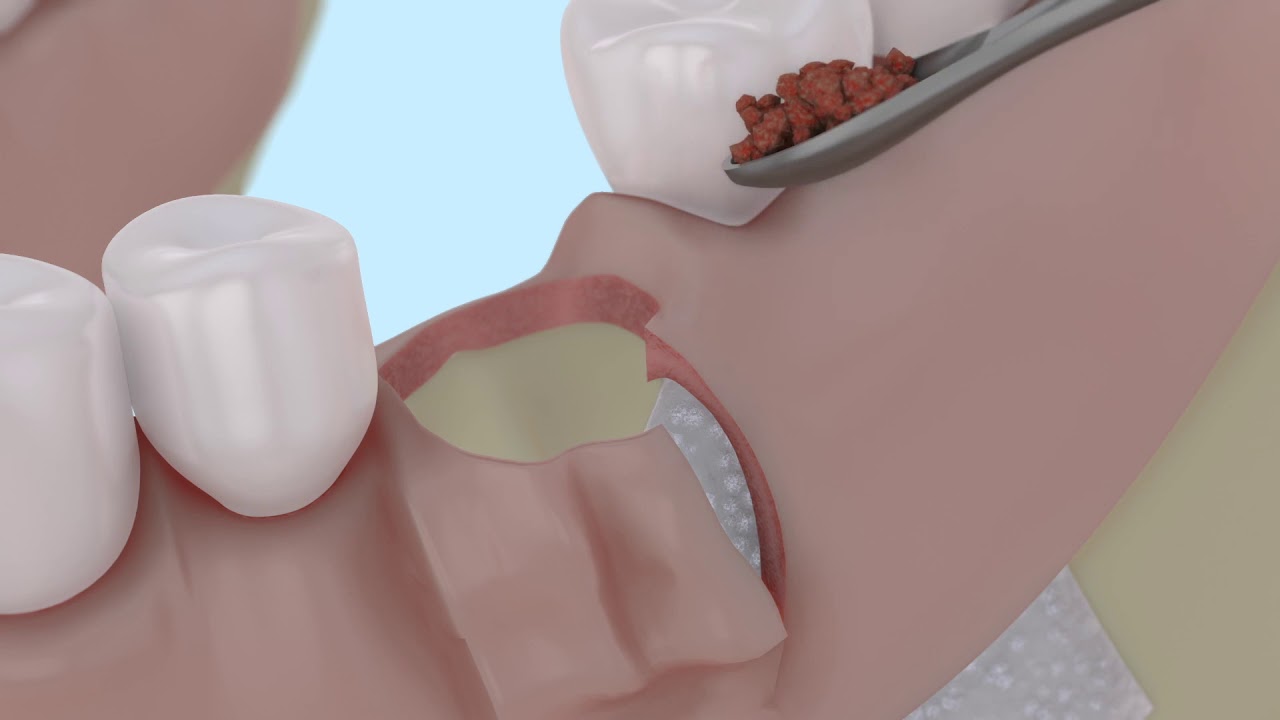 Операция №2 Консервация альвеолы после удаления зуба с дефектом одной стенки