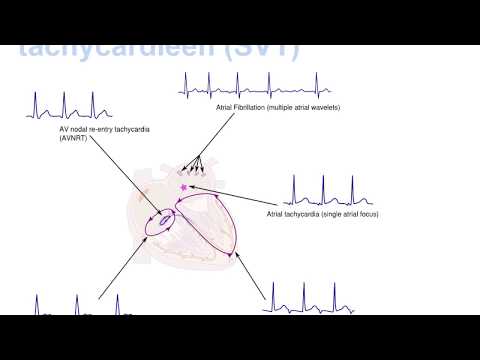 E-Learning 3 Ritmestoornissen