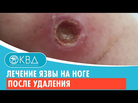 Открытая рана как лечить в домашних условиях