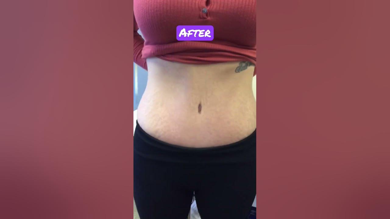 Tummy Tuck Before and After on Mom of Triplets! tummytuckbeforeandafter YouTube