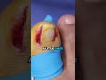 Removing the INGROWN&#39;S Root so the toenail will grow better!! 🦶