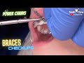 Braces checkups - 10 years old | Upper Power Chain | Tooth Time Family Dentistry