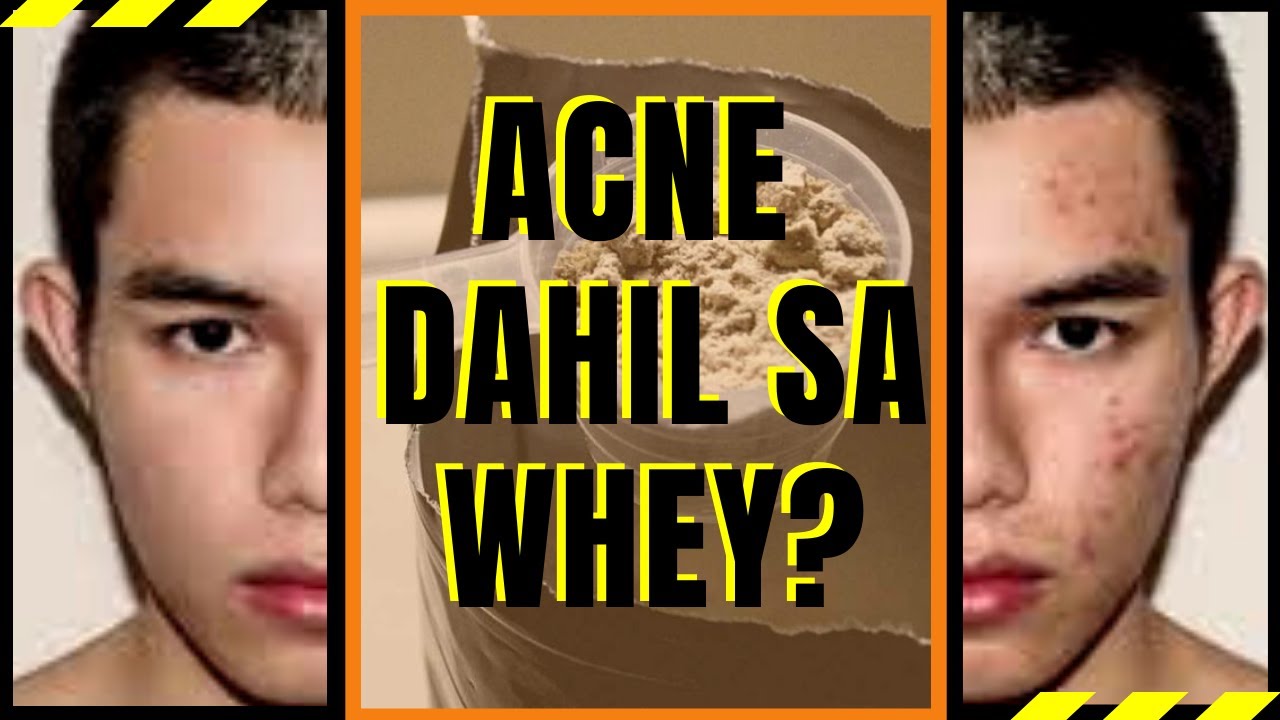 ACNE DAHIL SA WHEY PROTEIN [ Totoo ba mag kakaroon ng PIMPLES dahil sa