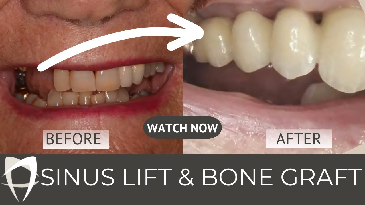 Sinus Lift & Bone Graft