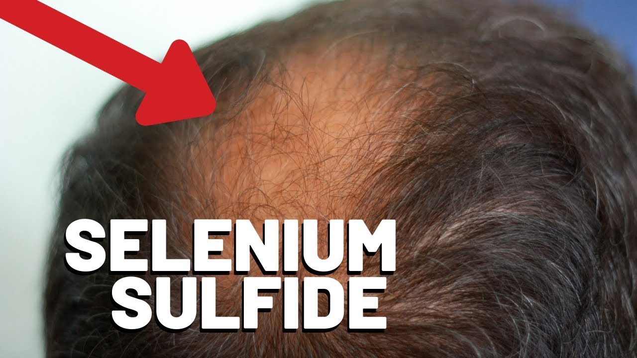 2. Can Selsun Blue Cause Hair Loss? - wide 4