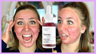 THE ORDINARY PEELING SOLUTION REVIEW | WILL IT BURN MY FACE OFF?!? DOES IT WORK???