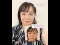 【整形後の変化】脂肪吸引と糸リフトしたよ【30日】#脂肪吸引　#ダウンタイム #整形 #美容整形 #アラフォー#糸リフト#顔脂肪 #コンプレックス #初整形#顎下#小顔整形 #アンチエイジング