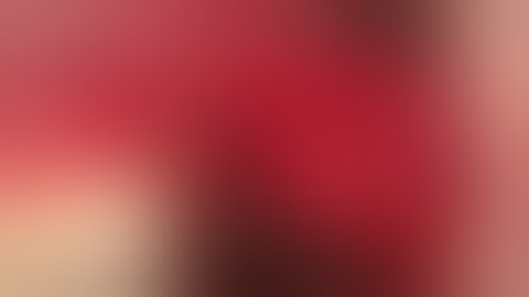 Lateral augmentation using Bond Apatite bone graft  Cement.Augma Biomaterials