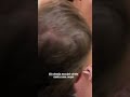 MINI ABDOMINOPLASTIA + LIPO HD: Transformando o corpo na cicatriz da cesárea! 😱✨