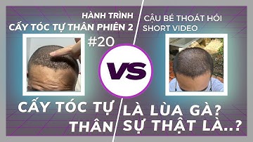 CẤY TÓC TỰ THÂN LÀ LÙA GÀ? SỰ THẬT ĐẰNG SAU ĐÓ? #20 l HÀNH TRÌNH CẤY TÓC