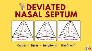 Deviated Nasal Septum (DNS) | Causes, Types, Symptoms, Treatment