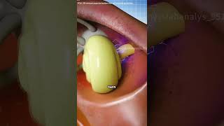 Cochlear Implant Surgery Procedure Medical Animation #science #doctor #3danimation #anatomy #cochlea
