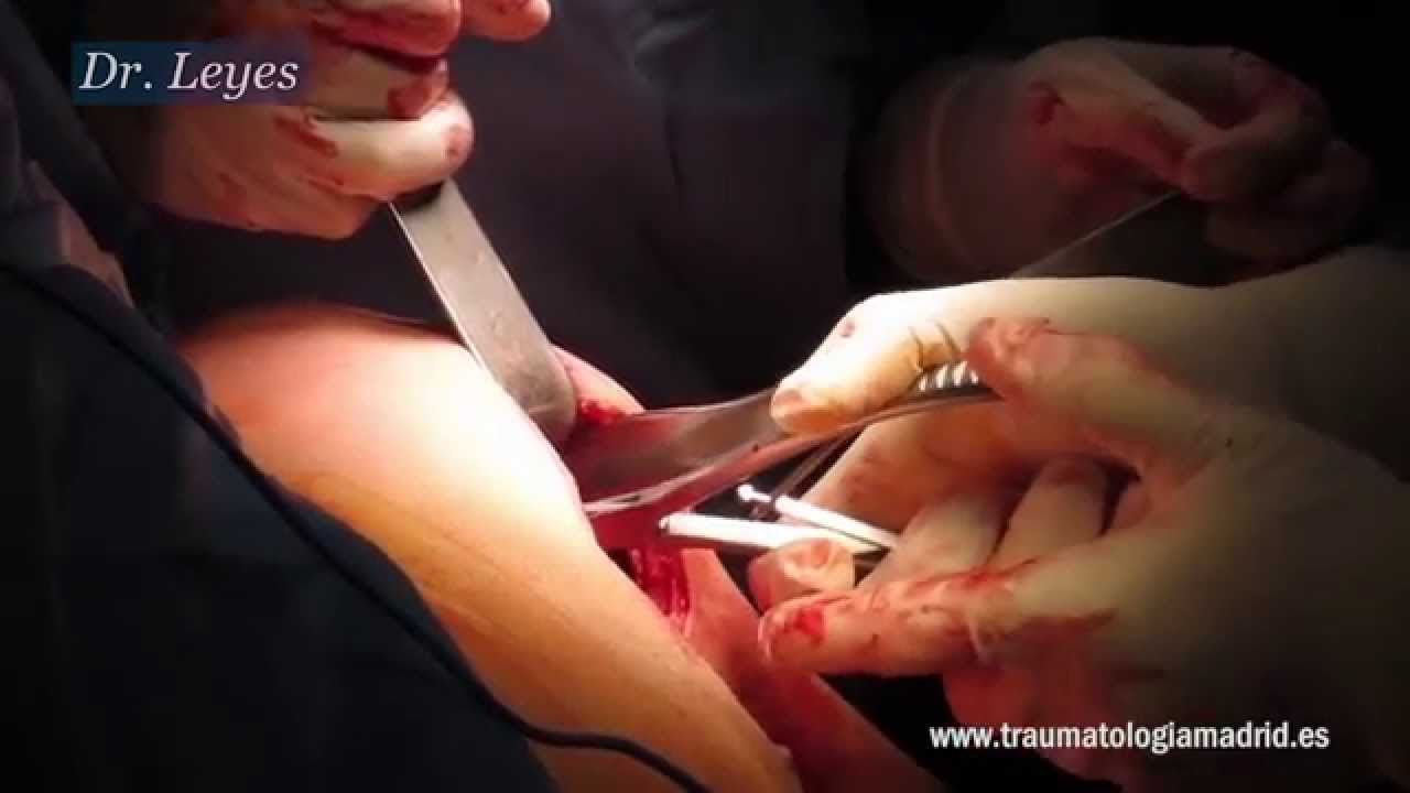Intervención quirúrgica de una ruptura del pectoral mayor realizada por el Dr. Leyes major field of study medicine