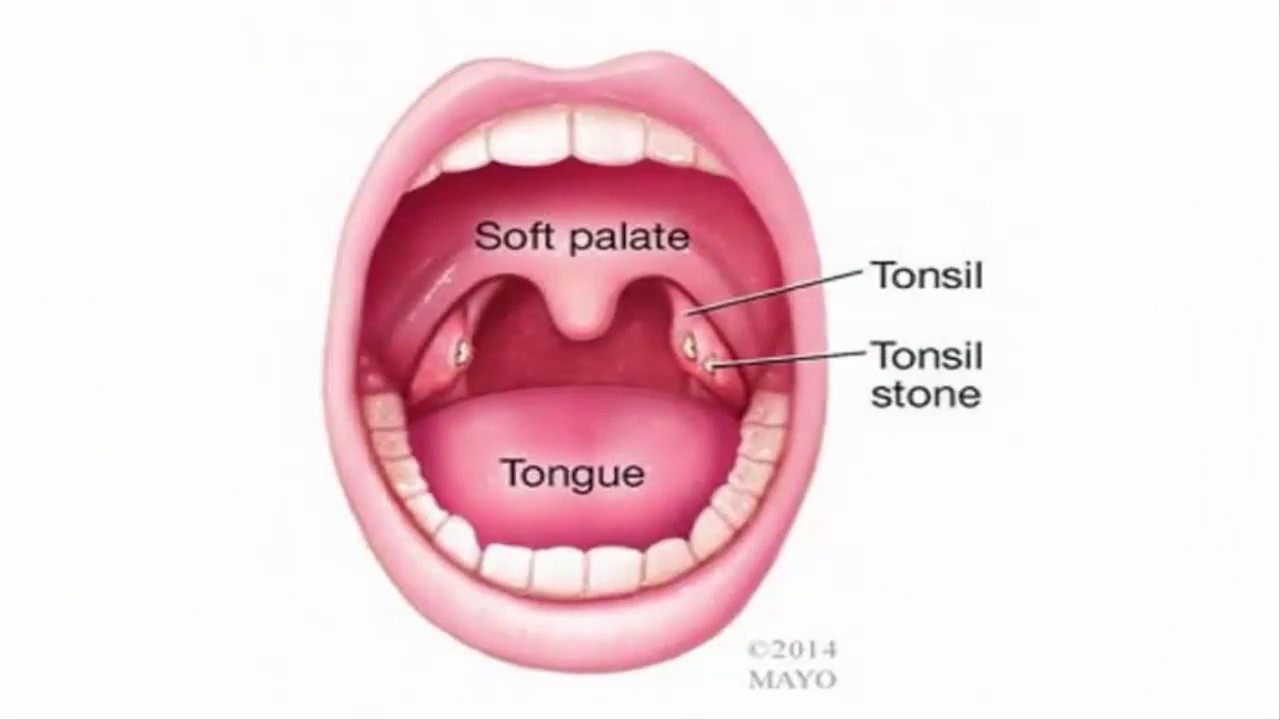 Tonsil Stones Causes, Removal & Prevention YouTube