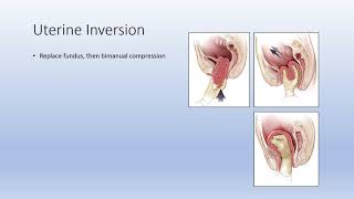 Uterine Inversion