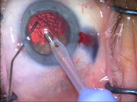 Fibrosed cataract , posterior assited levitation/P...