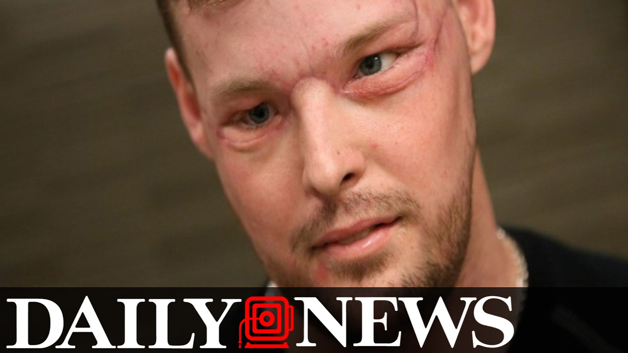 Face Transplant Patient Thrilled With Results Of The Operation