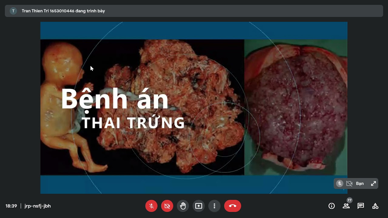 Outline Video Bình BA thai trứng Cô Khánh Nga