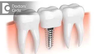 How do I know if I need a bone graft for Dental Implants? Dr. Sharon Colaco Dias