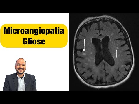 Vídeo: A gliose pode ser curada?