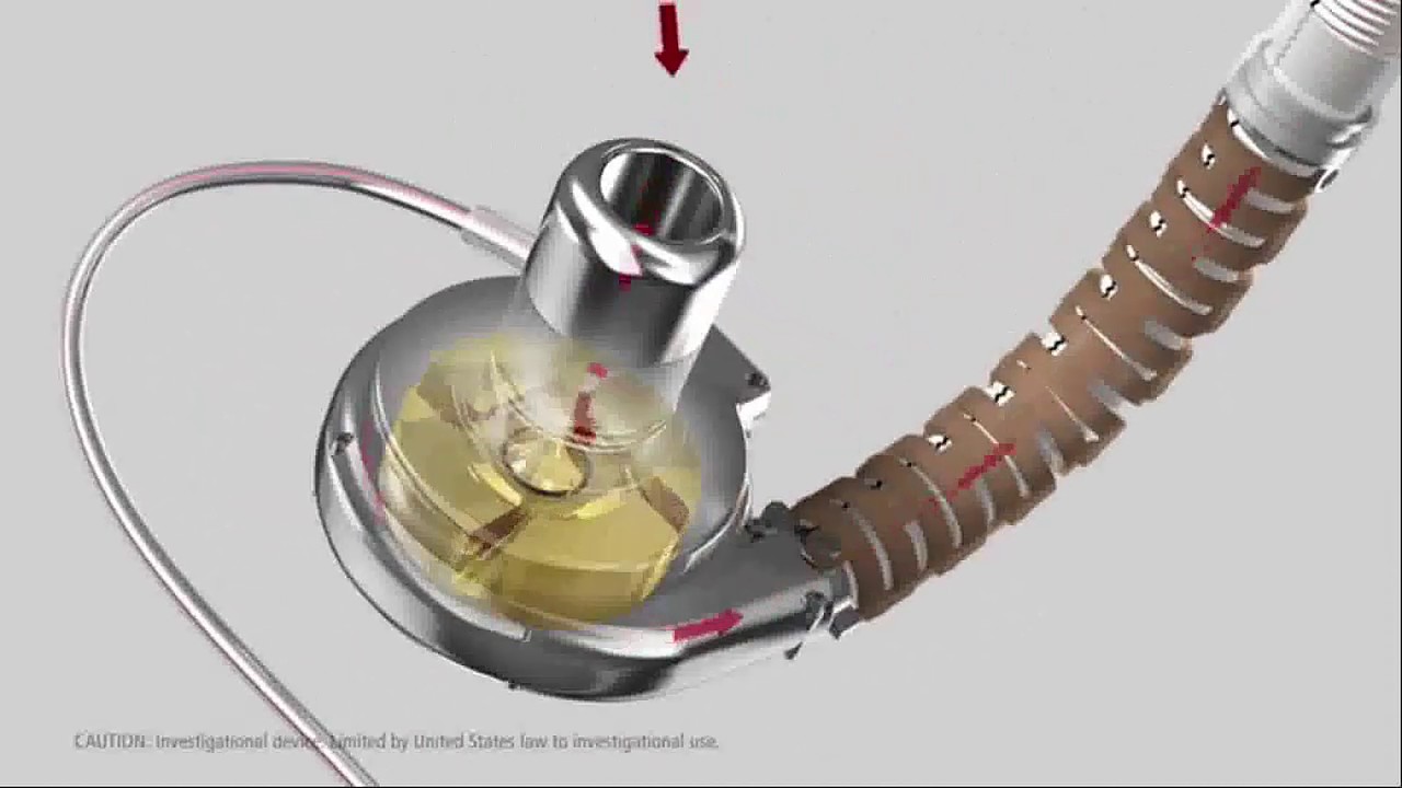 heartware ventricular assist system youtube