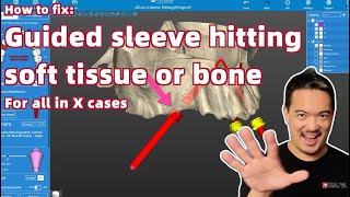 Managing Sleeve-to-Bone Collisions: DAS Guided Kit x RealGUIDE Tutorial for all on X cases
