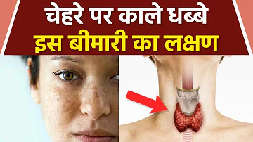 चेहरे पर काले धब्बे होना Thyroid Symptoms | Face Black Spots से Thyroid कैसे होता है | Boldsky